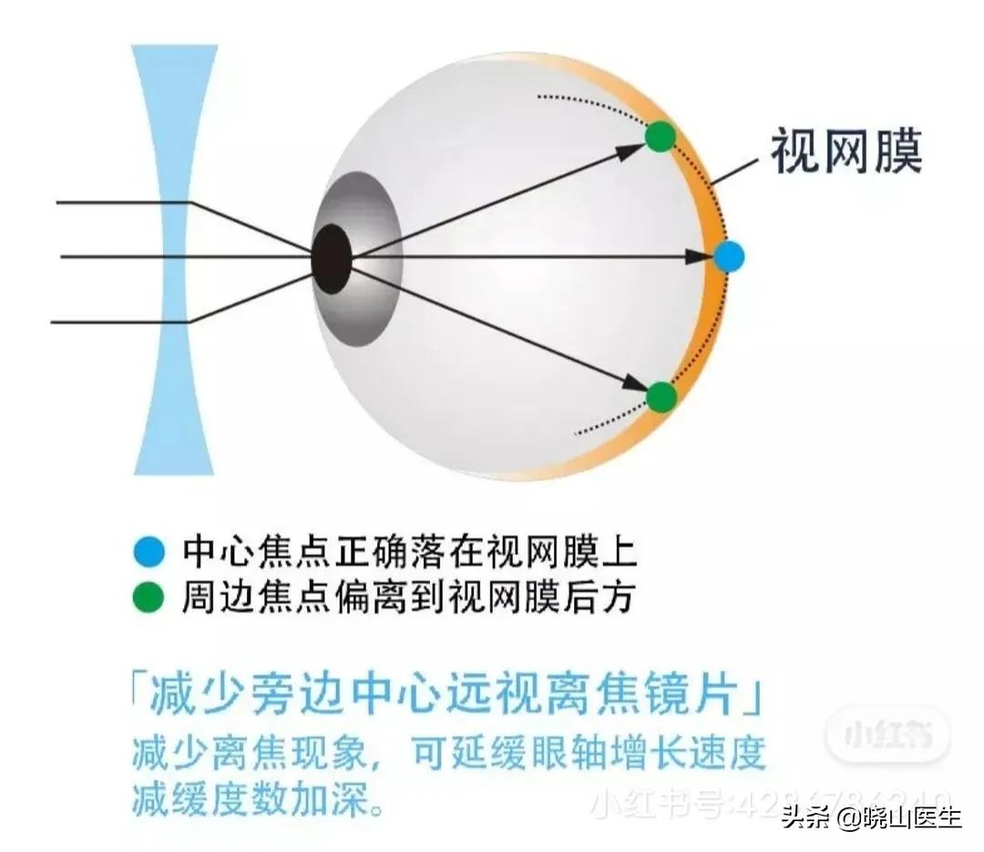 大夫不建议使用星趣控镜片