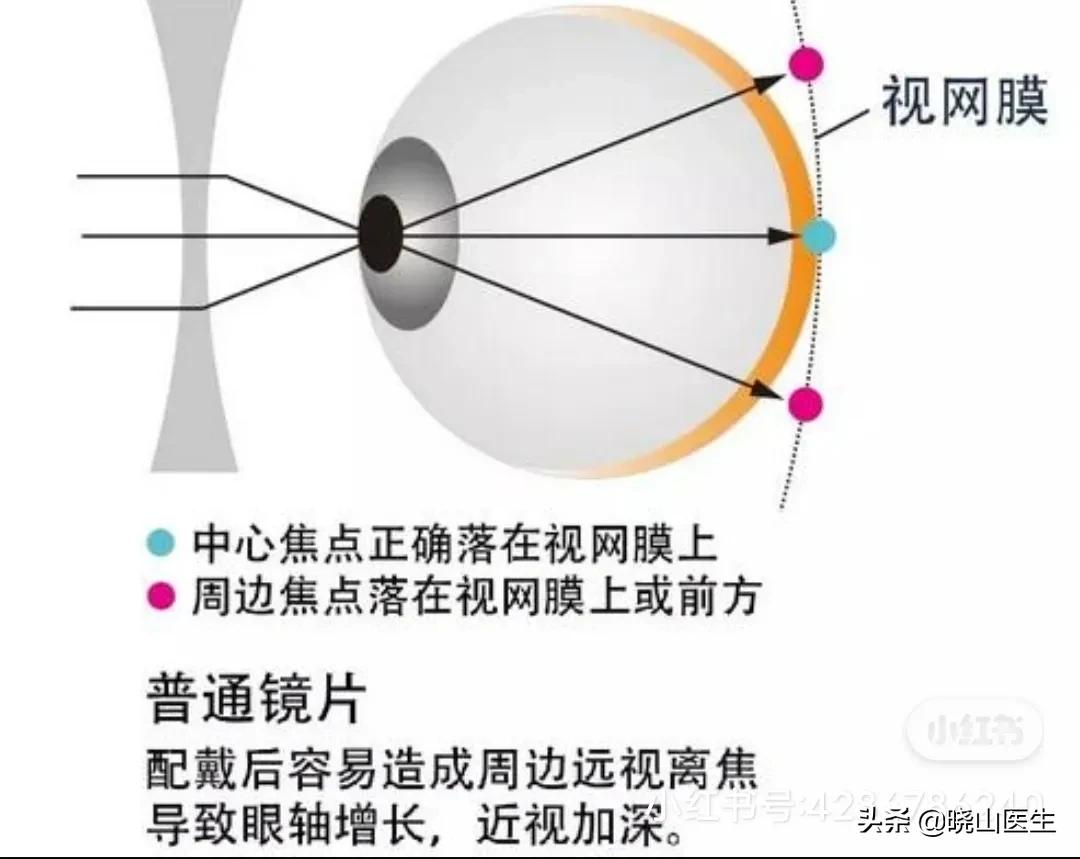 大夫不建议使用星趣控镜片