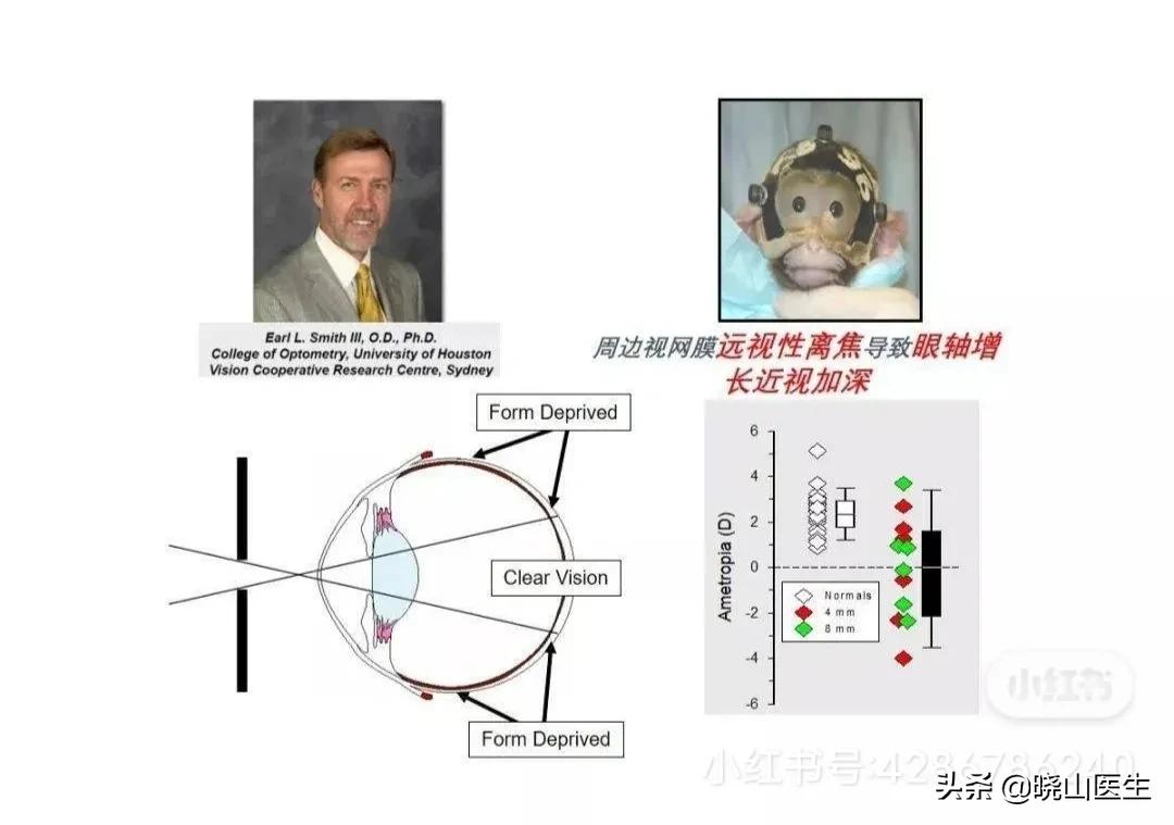 大夫不建议使用星趣控镜片