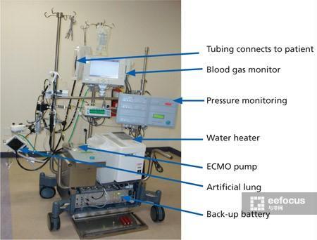 ecmo是什么意思(ecmo和呼吸机的区别)
